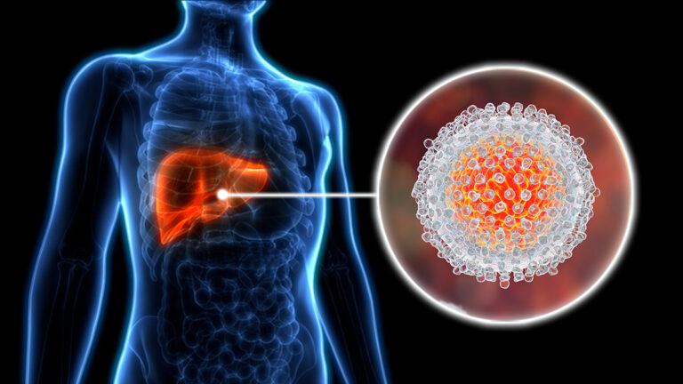 Kashmir has witnessed an alarming rise in Hepatitis A cases, particularly in regions with insufficient sanitation and compromised water supply systems